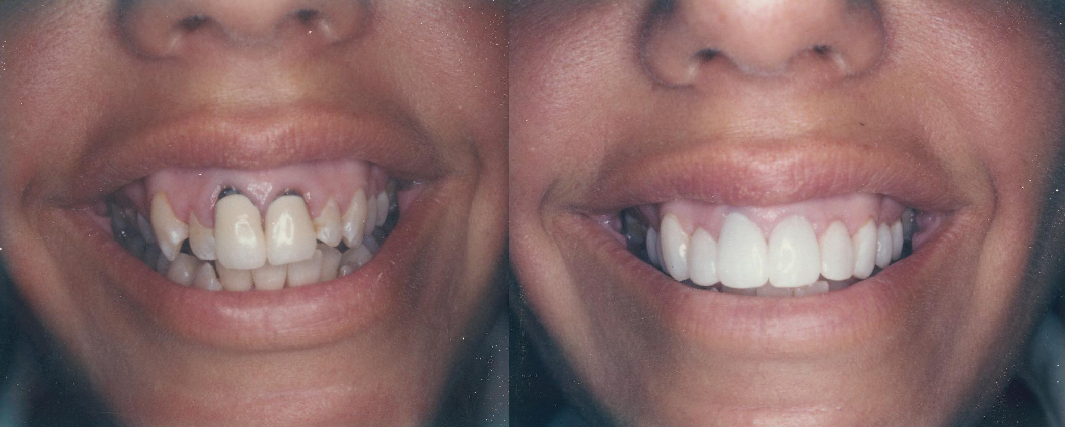 Invisalign Braces Before and After Review [VIDEO]