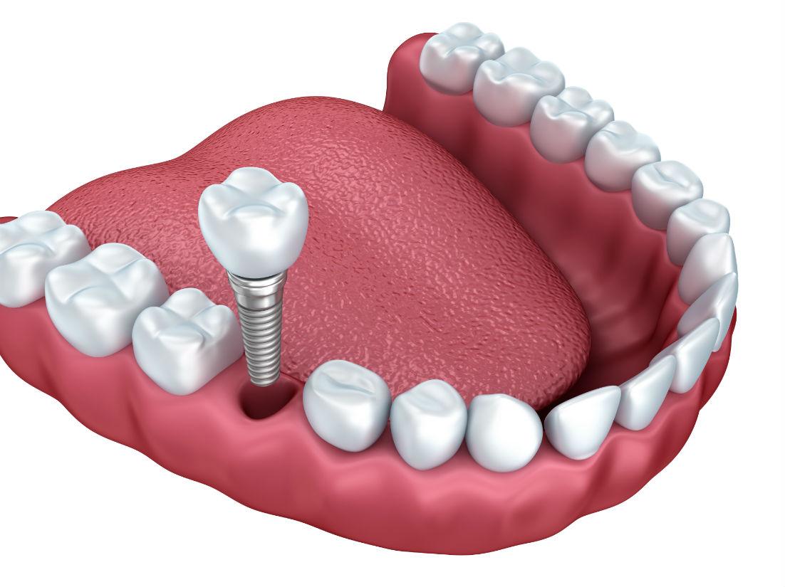 Dental Implants Morgantown WV