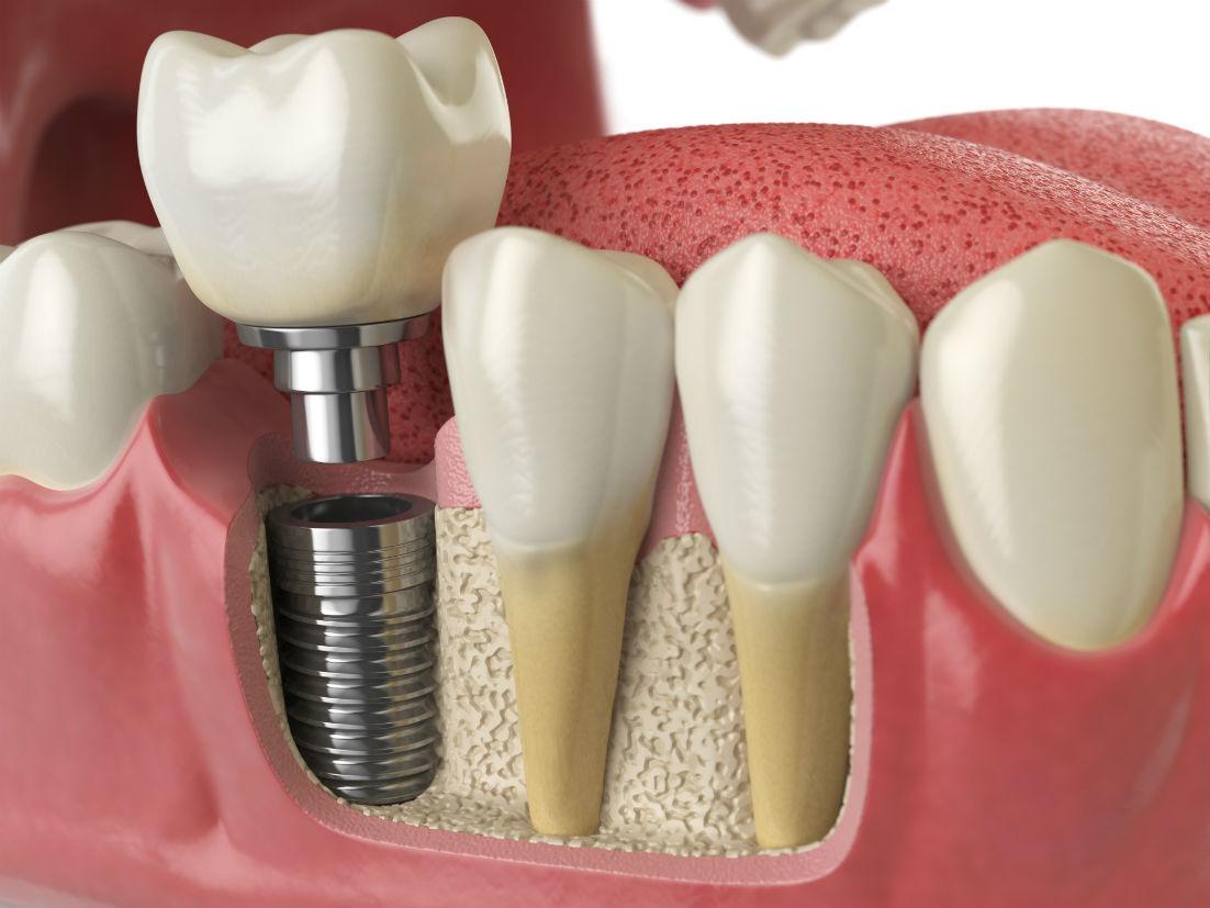 Time to Consider Dental Implants?